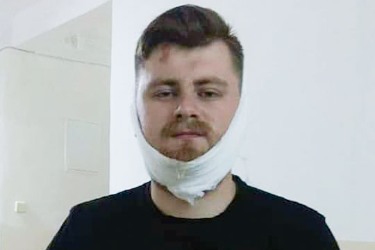 Воевавшему в Донбассе сломали челюсть за выкрик «Слава Украине!»