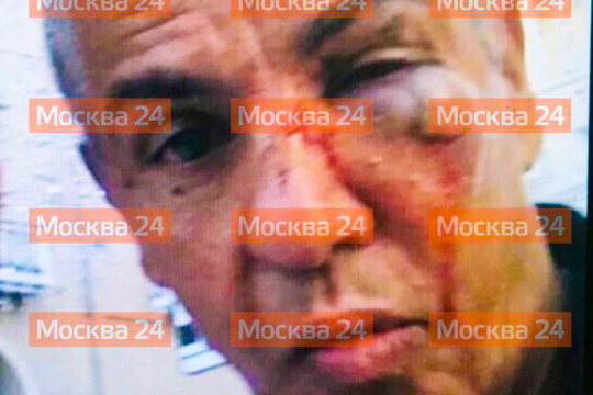 Появилось фото избитого в Москве французского актера Сами Насери
