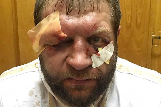 Емельяненко показал разбитое лицо после боя с американцем